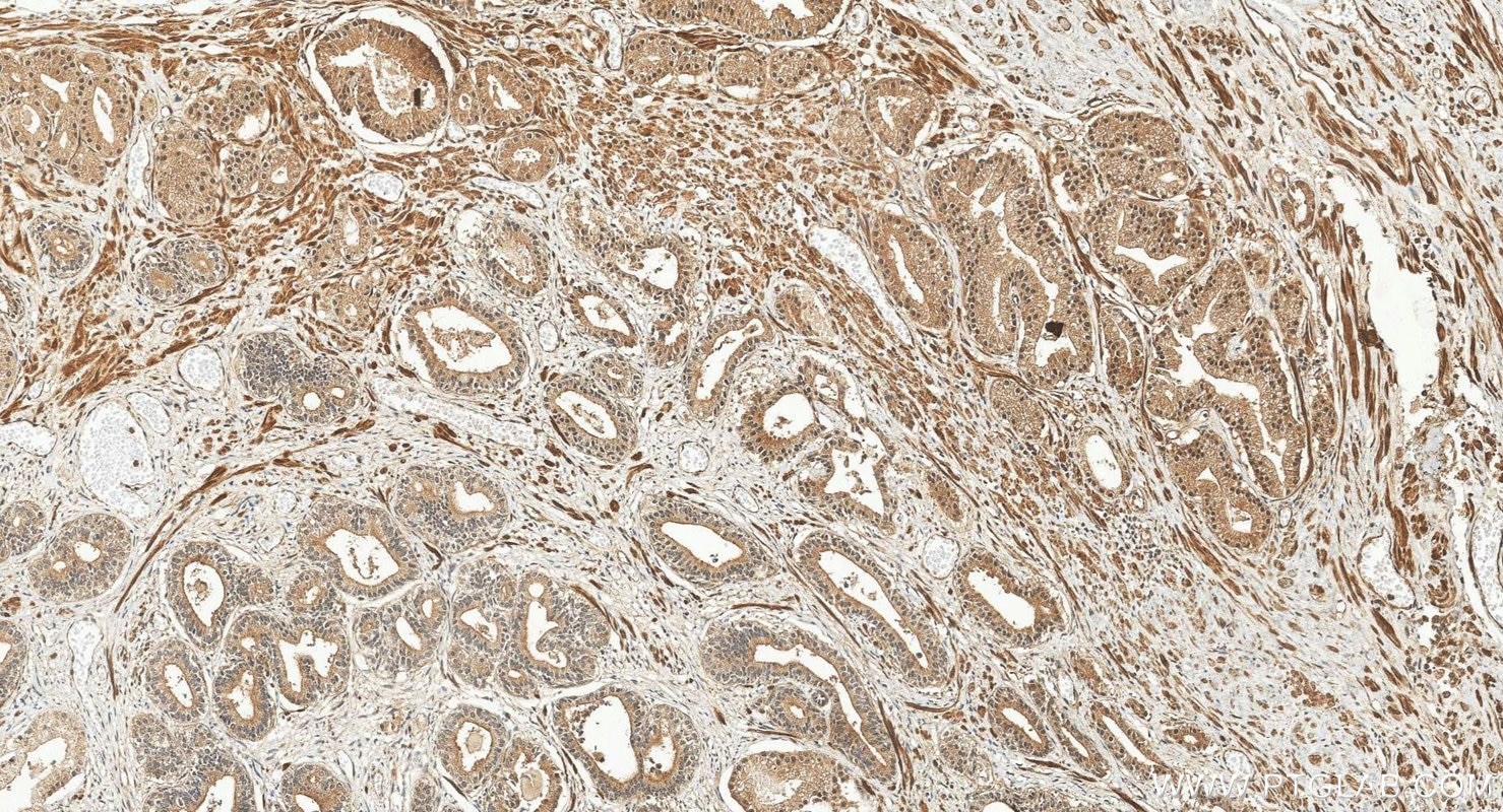 Immunohistochemistry (IHC) staining of human prostate cancer tissue using RBM27 Polyclonal antibody (31850-1-AP)