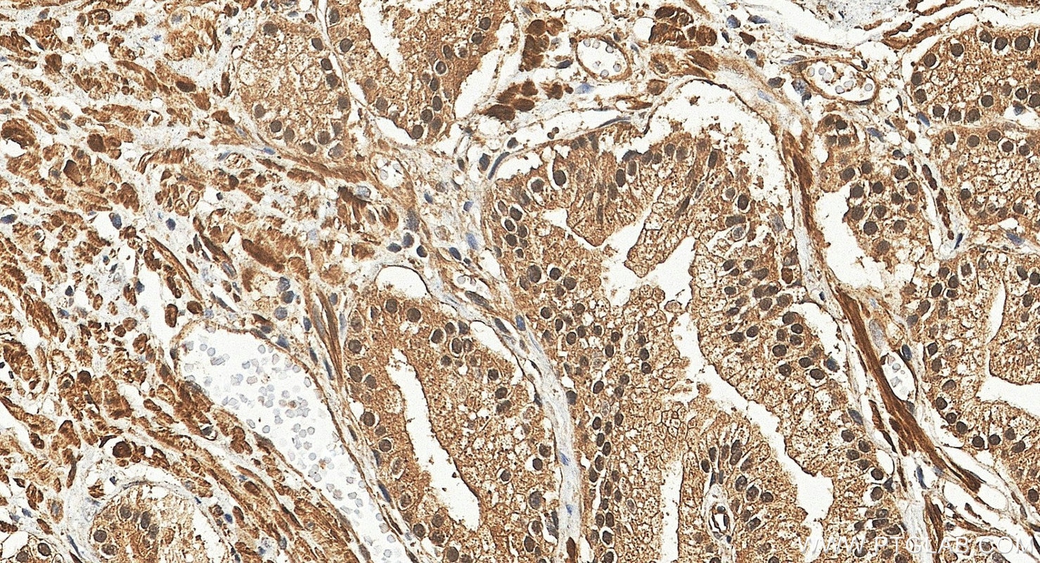 Immunohistochemistry (IHC) staining of human prostate cancer tissue using RBM27 Polyclonal antibody (31850-1-AP)