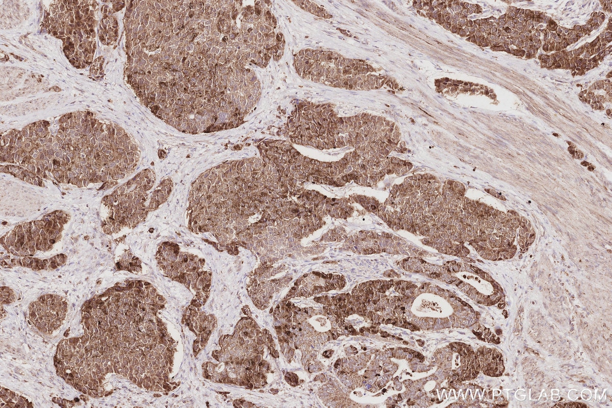 IHC staining of human stomach cancer using 16435-1-AP Immunohistochemistry (IHC) staining of human stomach cancer tissue using RBM38 Polyclonal antibody (16435-1-AP)
