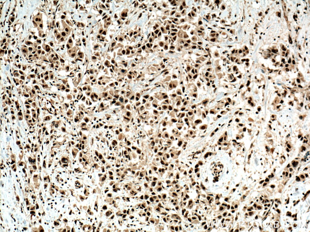 Immunohistochemistry (IHC) staining of human breast cancer tissue using RBM39 Monoclonal antibody (67420-1-Ig)