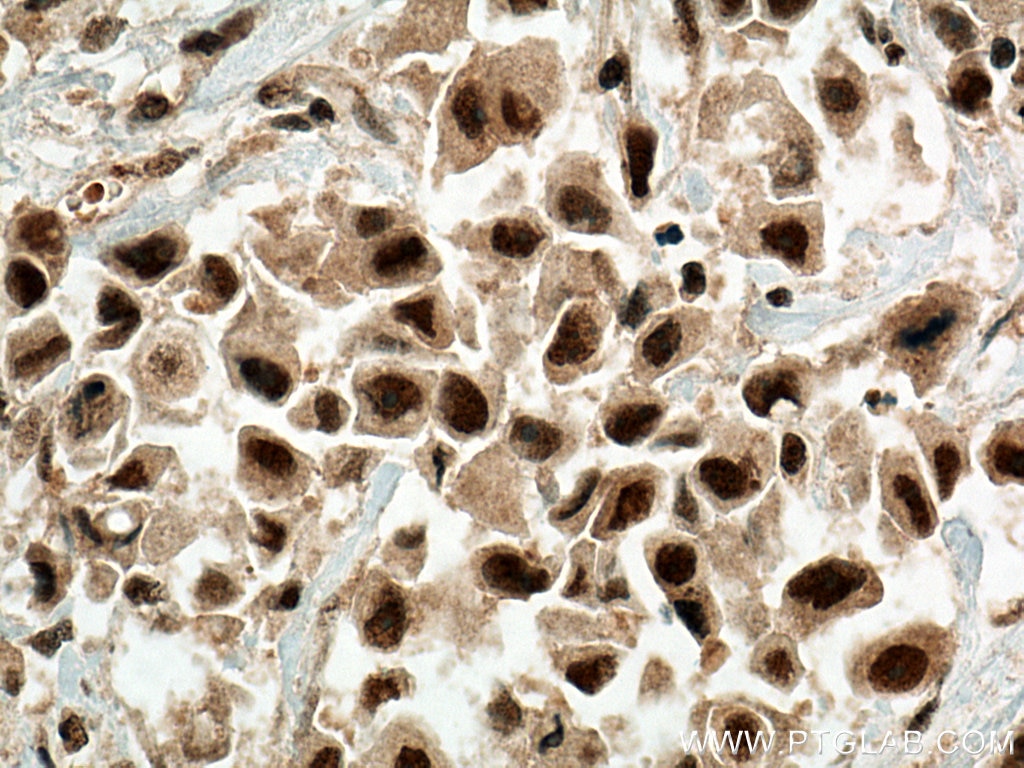 Immunohistochemistry (IHC) staining of human breast cancer tissue using RBM39 Monoclonal antibody (67420-1-Ig)
