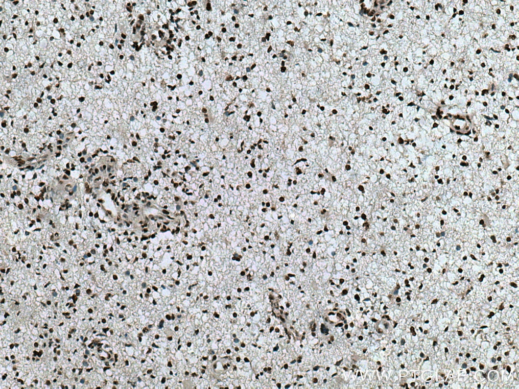 Immunohistochemistry (IHC) staining of human gliomas tissue using RBM4 Polyclonal antibody (11614-1-AP)
