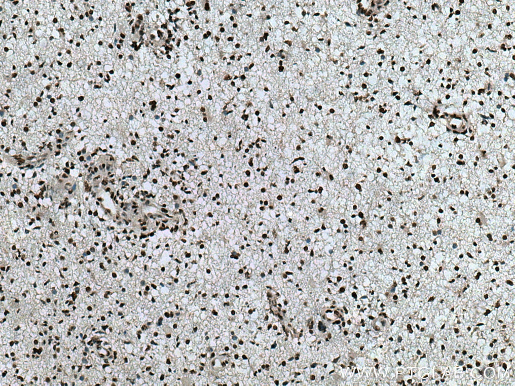 IHC staining of human gliomas using 11614-1-AP