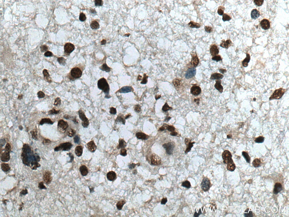 Immunohistochemistry (IHC) staining of human gliomas tissue using RBM4 Polyclonal antibody (11614-1-AP)