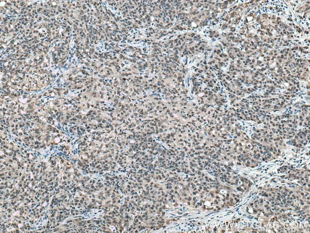 Immunohistochemistry (IHC) staining of human stomach cancer tissue using RBM4 Polyclonal antibody (11614-1-AP)