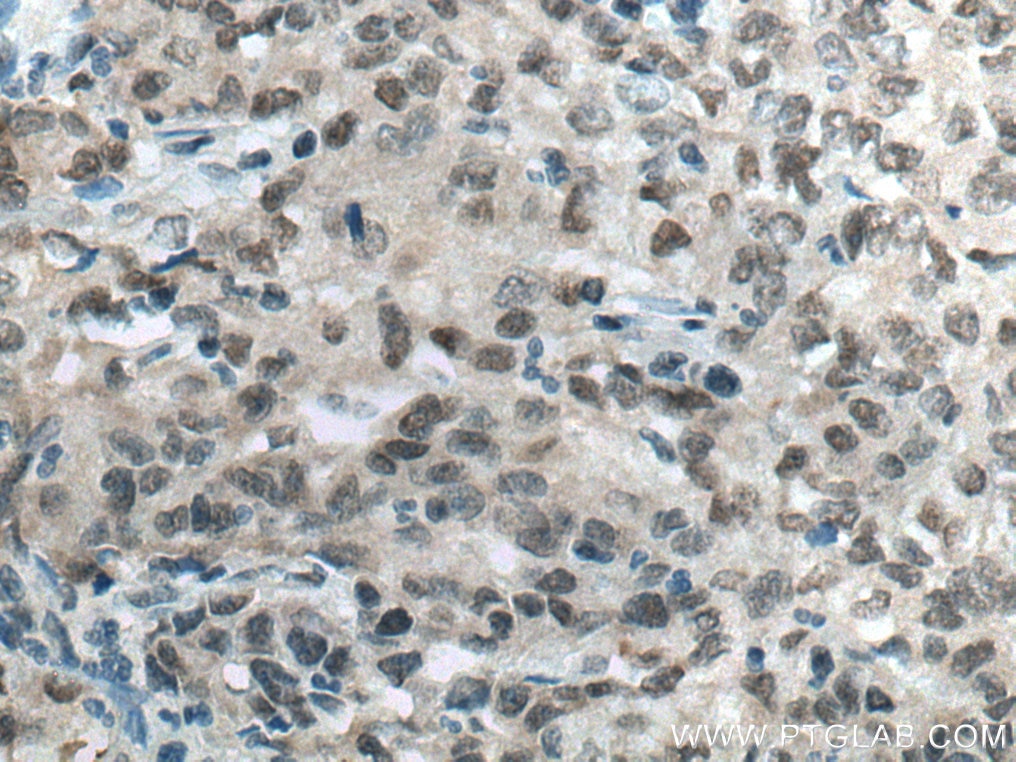Immunohistochemistry (IHC) staining of human stomach cancer tissue using RBM4 Polyclonal antibody (11614-1-AP)