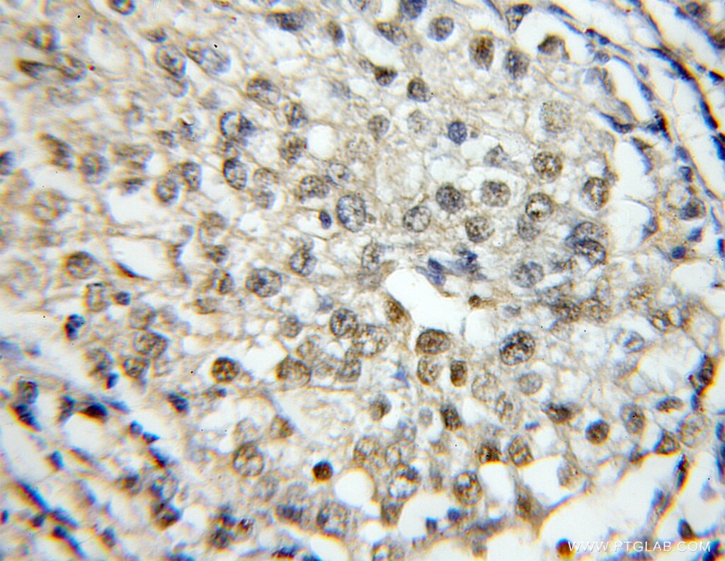 Immunohistochemistry (IHC) staining of human lung cancer tissue using RBM4 Polyclonal antibody (11614-1-AP)