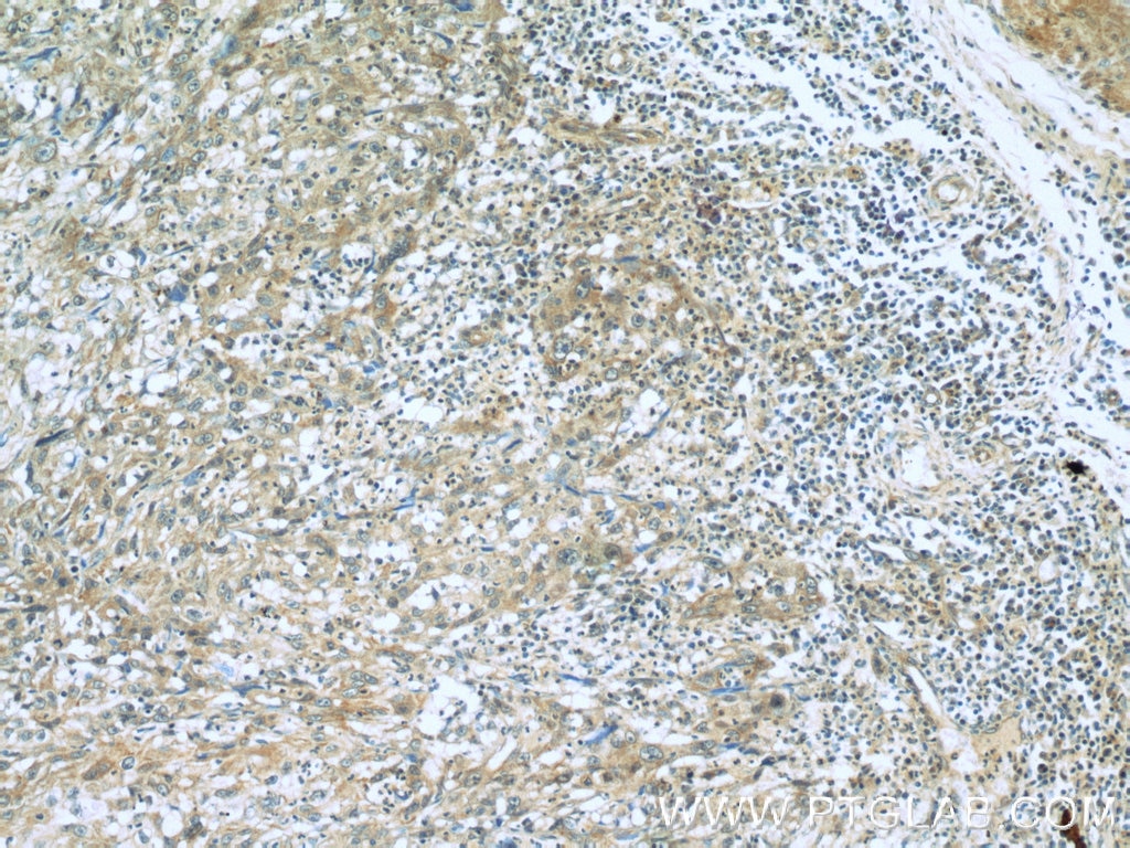 Immunohistochemistry (IHC) staining of human cervical cancer tissue using RBM4 Monoclonal antibody (60292-1-Ig)