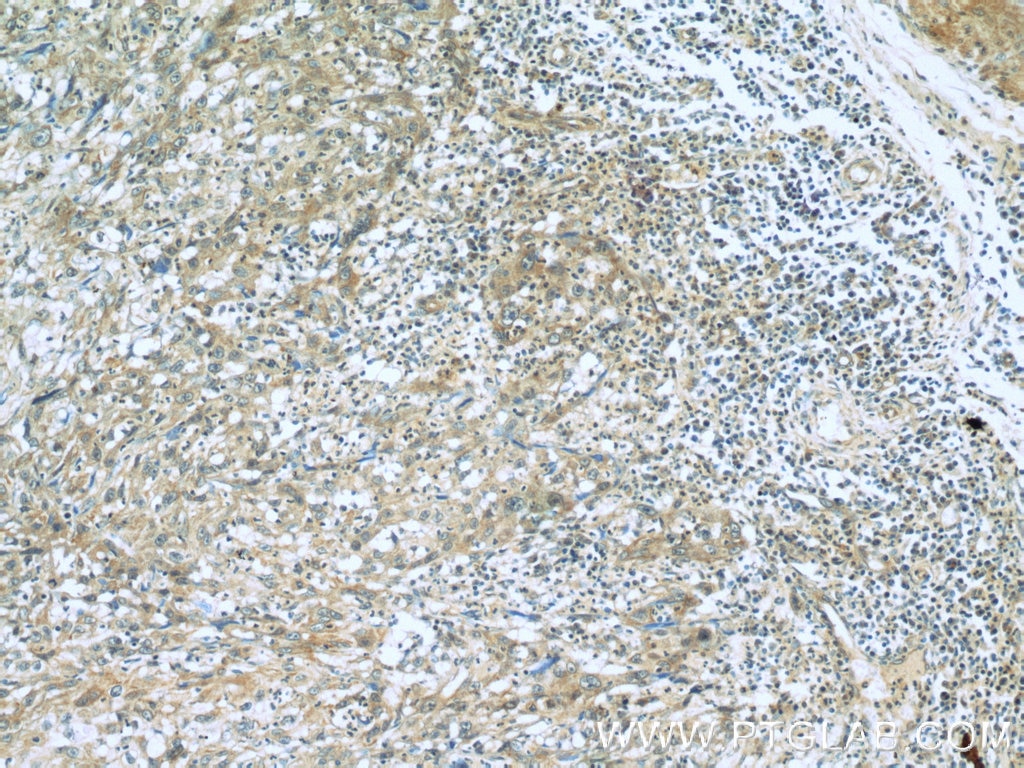 Immunohistochemistry (IHC) staining of human cervical cancer tissue using RBM4 Monoclonal antibody (60292-1-Ig)