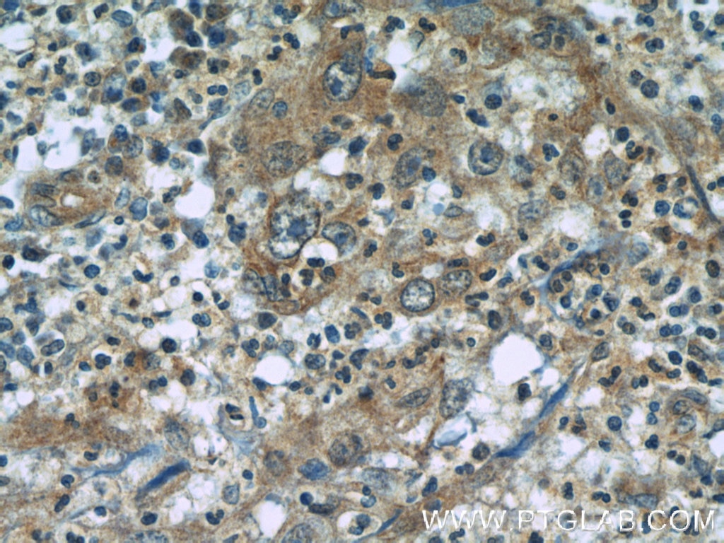 Immunohistochemistry (IHC) staining of human cervical cancer tissue using RBM4 Monoclonal antibody (60292-1-Ig)