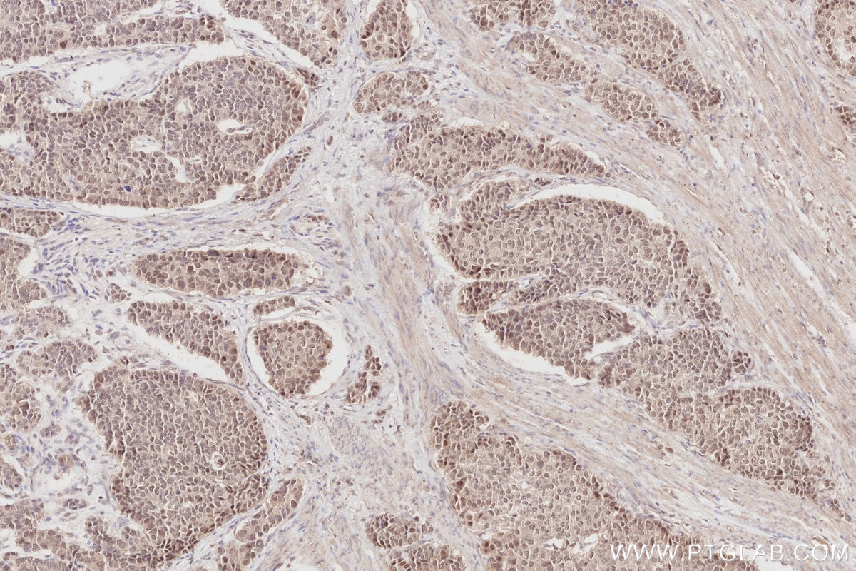 Immunohistochemistry (IHC) staining of human stomach cancer tissue using RBM4 Monoclonal antibody (60292-1-Ig)