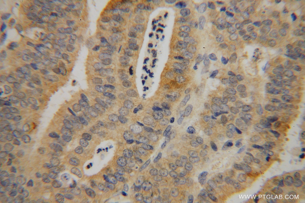 Immunohistochemistry (IHC) staining of human endometrial cancer tissue using RBM41 Polyclonal antibody (15784-1-AP)