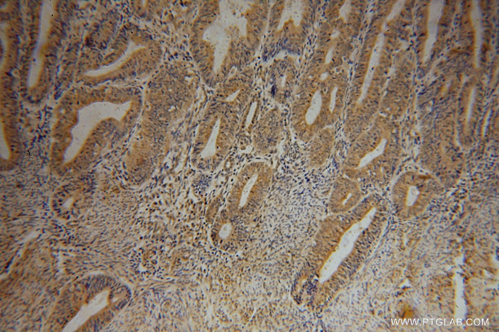 Immunohistochemistry (IHC) staining of human endometrial cancer tissue using RBM41 Polyclonal antibody (15784-1-AP)