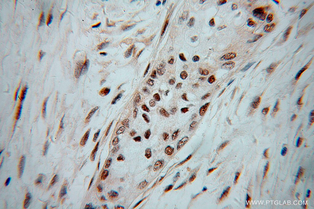 IHC staining of human pancreas cancer using 14360-1-AP
