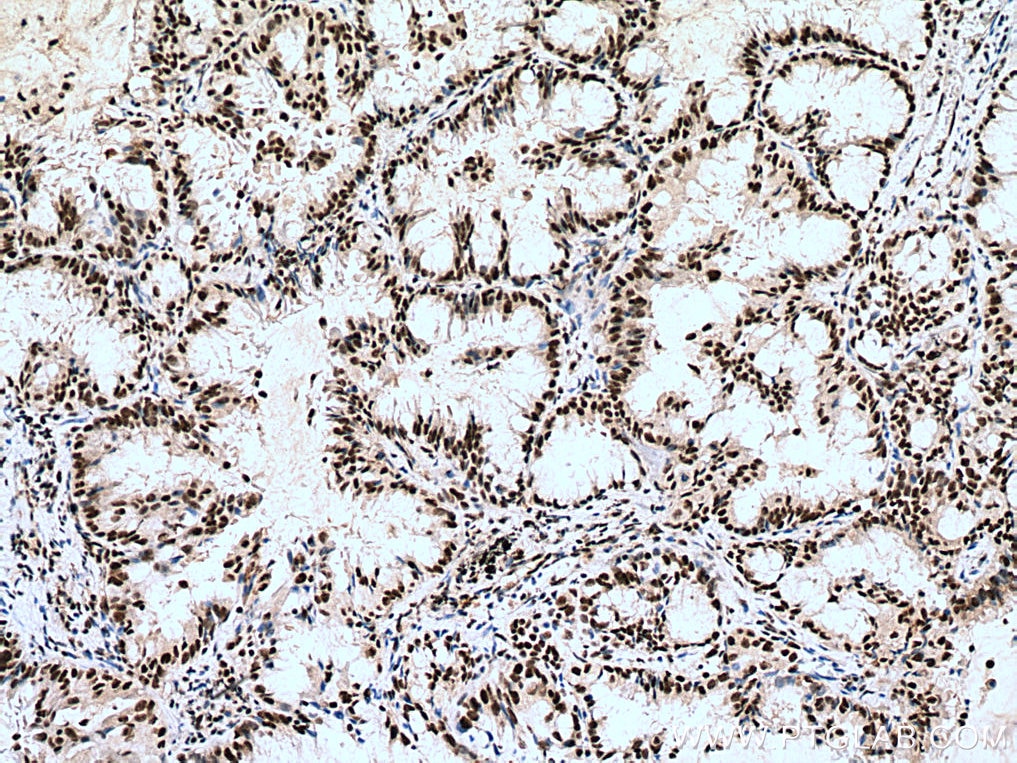 IHC staining of human lung cancer using 21896-1-AP