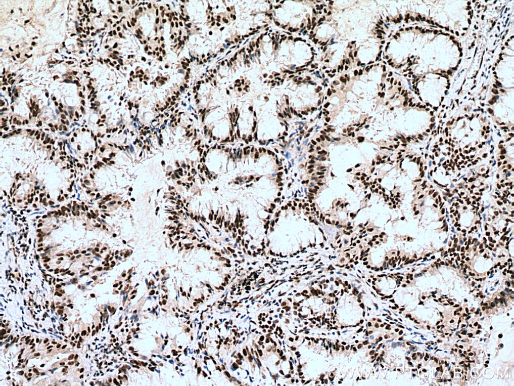 Immunohistochemistry (IHC) staining of human lung cancer tissue using RBM7 Polyclonal antibody (21896-1-AP)