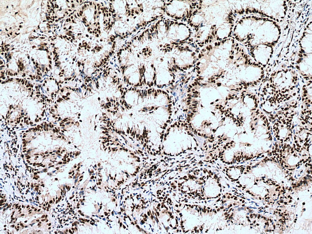 IHC staining of human lung cancer using 21896-1-AP