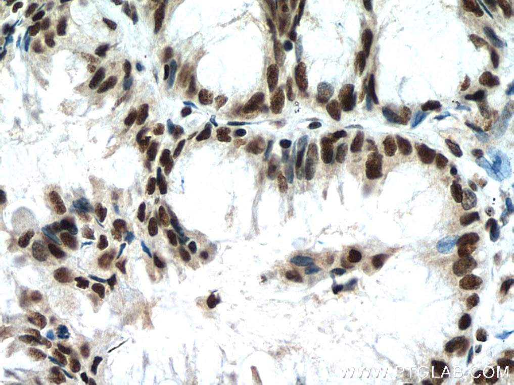 Immunohistochemistry (IHC) staining of human lung cancer tissue using RBM7 Polyclonal antibody (21896-1-AP)
