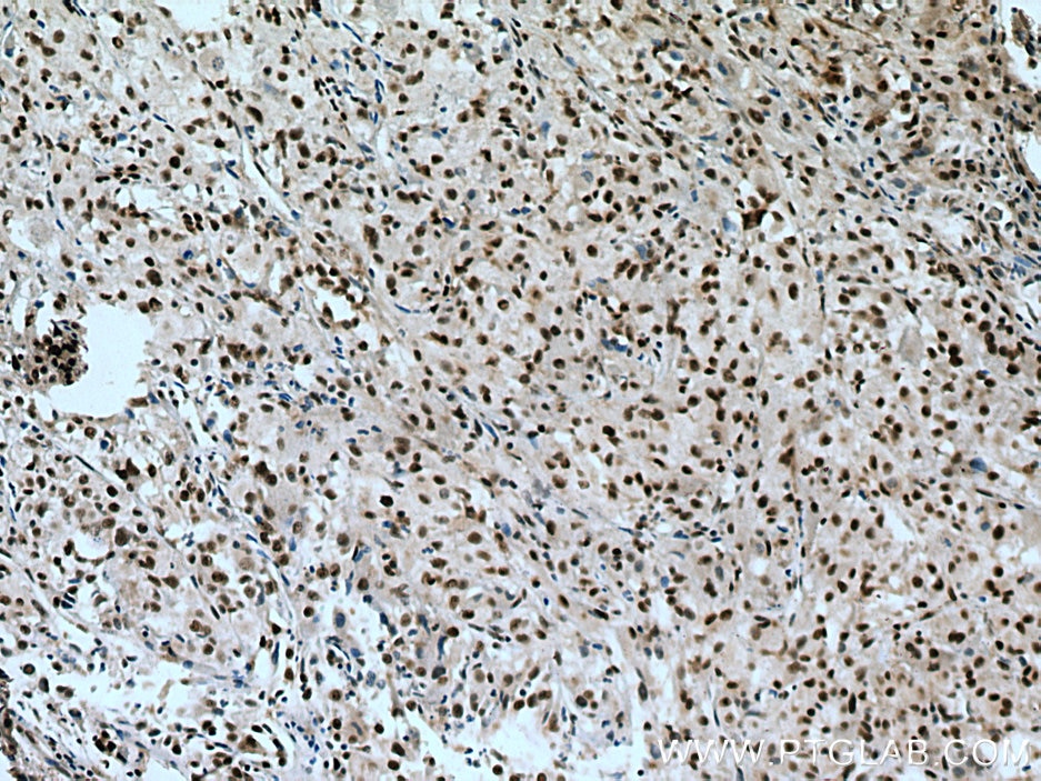 Immunohistochemistry (IHC) staining of human liver cancer tissue using RBM7 Polyclonal antibody (21896-1-AP)