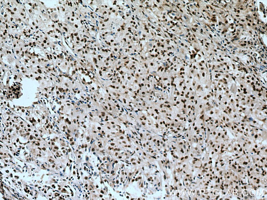 IHC staining of human liver cancer using 21896-1-AP