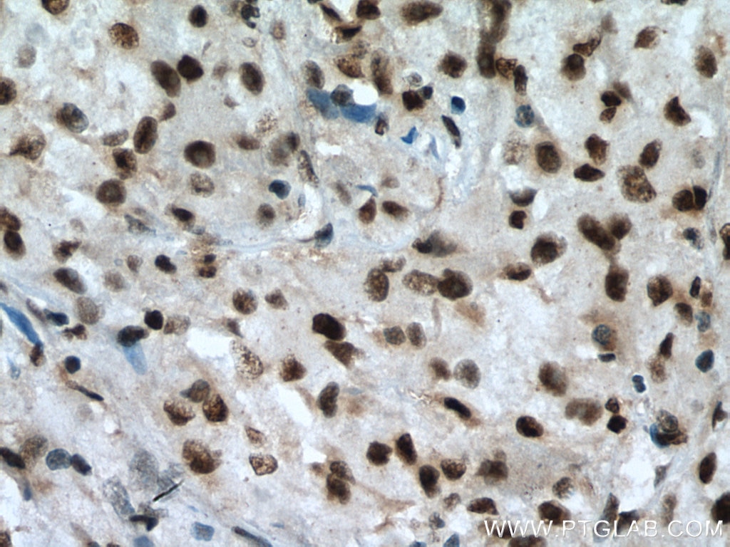 Immunohistochemistry (IHC) staining of human liver cancer tissue using RBM7 Polyclonal antibody (21896-1-AP)
