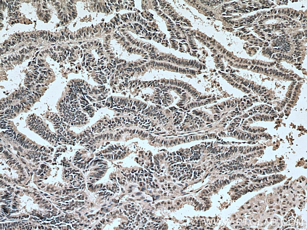 Immunohistochemistry (IHC) staining of human ovary tumor tissue using RBM8A,Y14 Monoclonal antibody (67541-1-Ig)