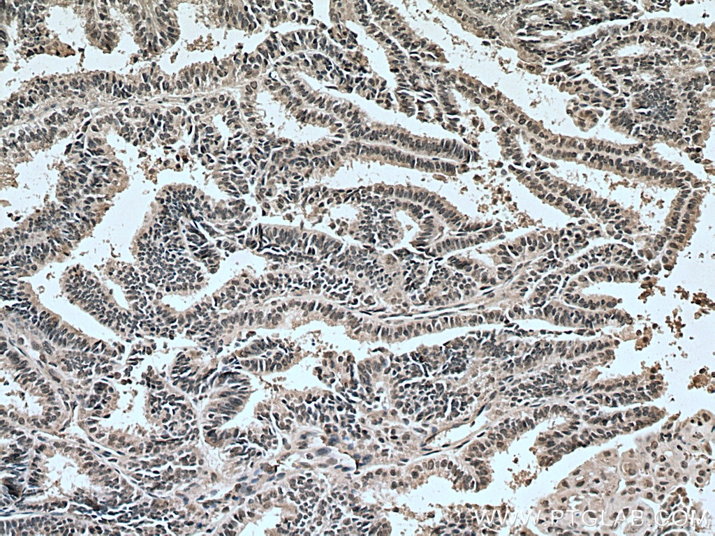 IHC staining of human ovary tumor using 67541-1-Ig