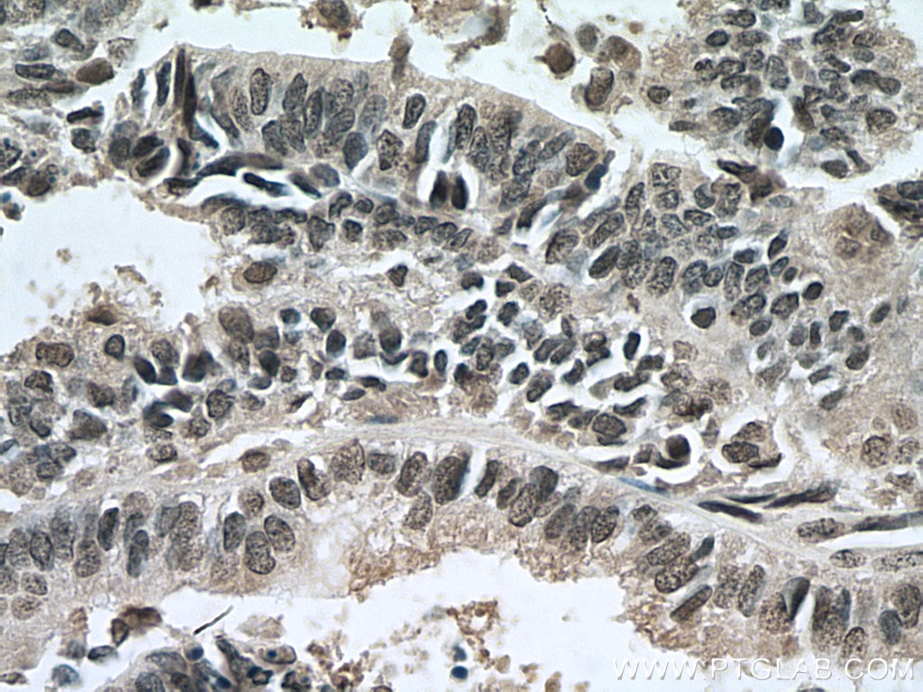 IHC staining of human ovary tumor using 67541-1-Ig