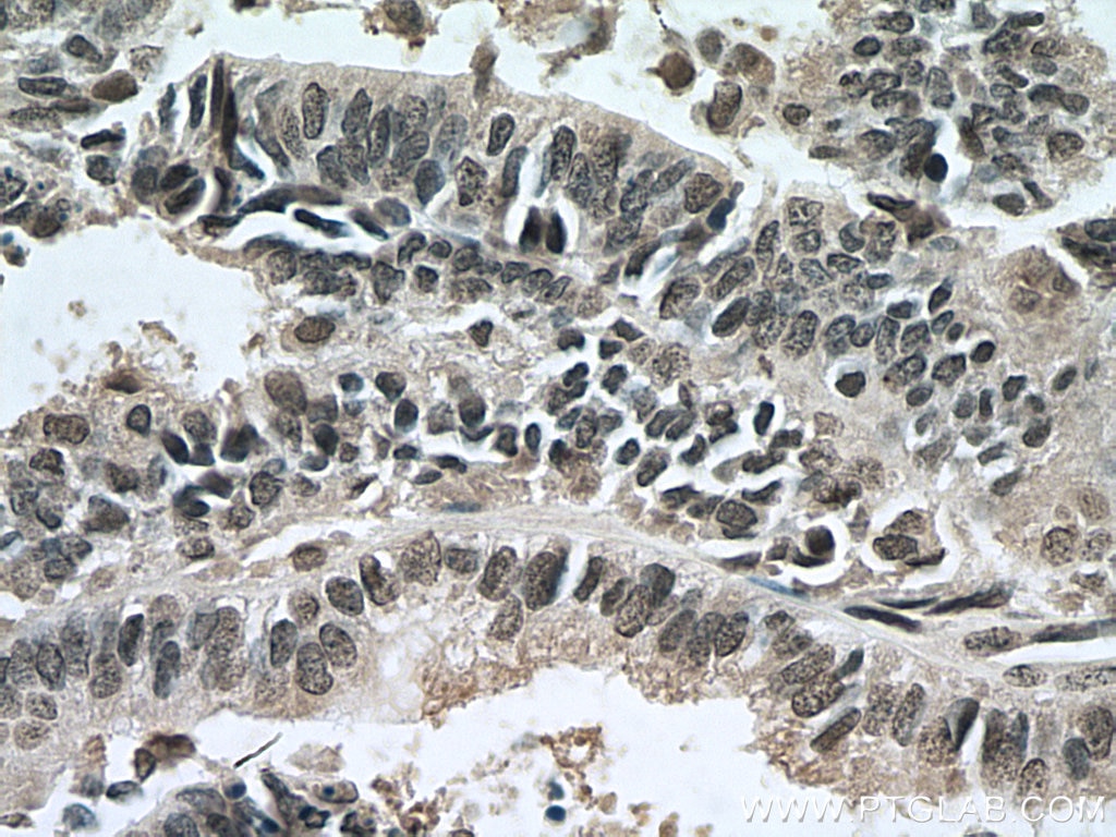 Immunohistochemistry (IHC) staining of human ovary tumor tissue using RBM8A,Y14 Monoclonal antibody (67541-1-Ig)