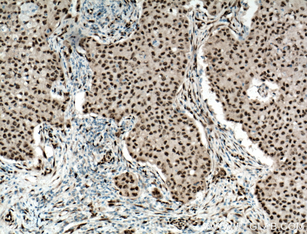 Immunohistochemistry (IHC) staining of human breast cancer tissue using FOX2/RBM9 Polyclonal antibody (12498-1-AP)