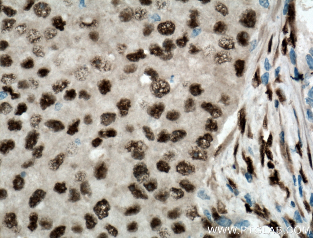 Immunohistochemistry (IHC) staining of human breast cancer tissue using FOX2/RBM9 Polyclonal antibody (12498-1-AP)