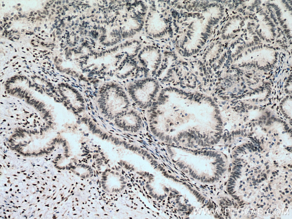 IHC staining of human ovary tumor using 12498-1-AP