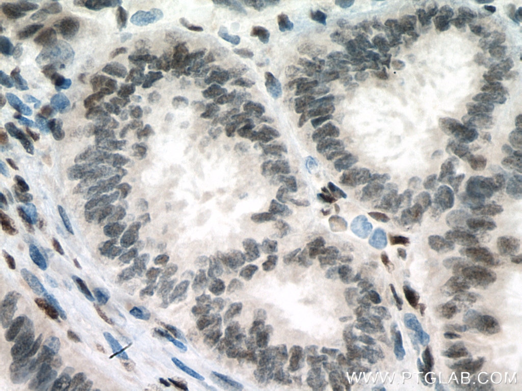 Immunohistochemistry (IHC) staining of human ovary tumor tissue using FOX2/RBM9 Polyclonal antibody (12498-1-AP)
