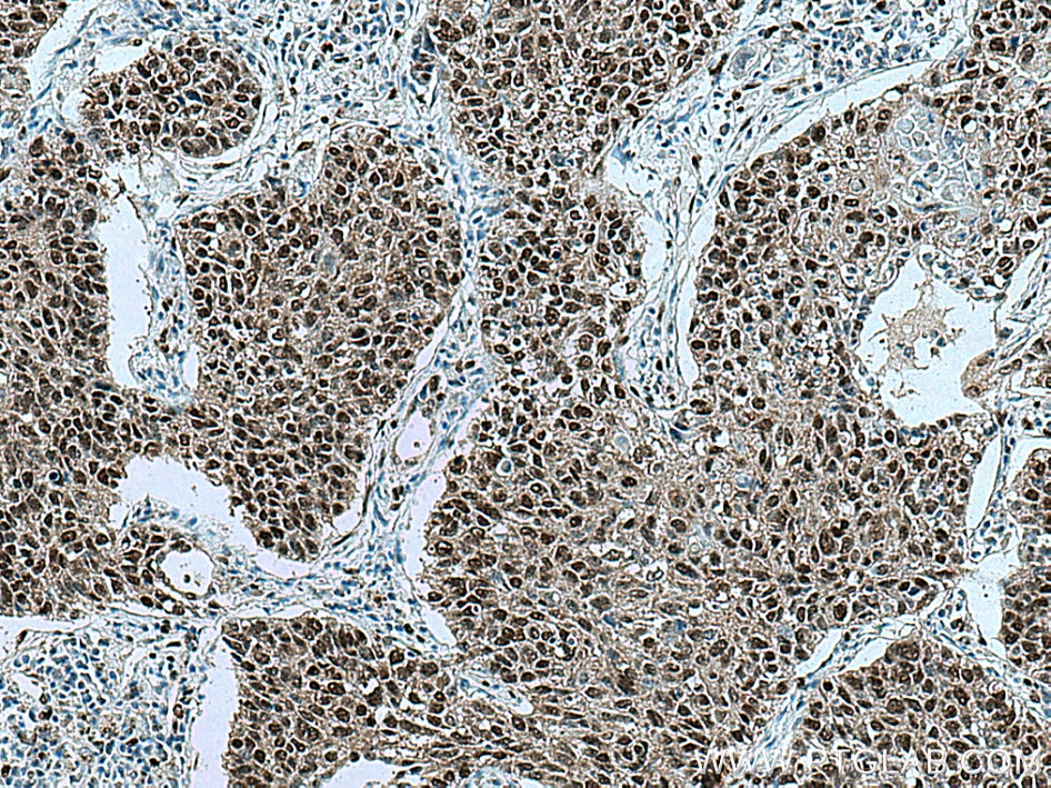 Immunohistochemistry (IHC) staining of human lung cancer tissue using FOX2/RBM9 Polyclonal antibody (12498-1-AP)