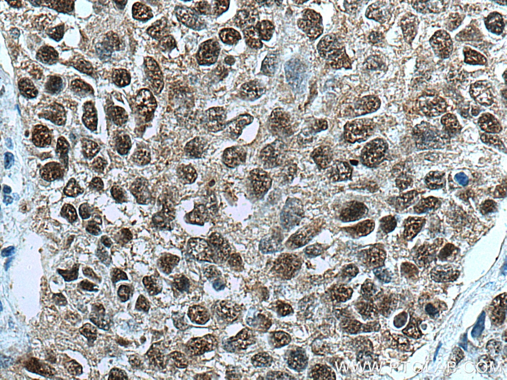 Immunohistochemistry (IHC) staining of human lung cancer tissue using FOX2/RBM9 Polyclonal antibody (12498-1-AP)