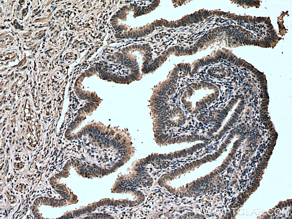 Immunohistochemistry (IHC) staining of human ovary tumor tissue using FOX2/RBM9 Monoclonal antibody (66976-1-Ig)