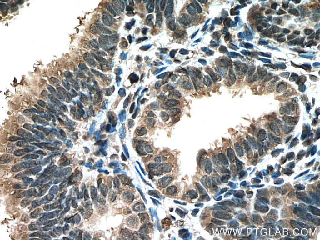 Immunohistochemistry (IHC) staining of human ovary tumor tissue using FOX2/RBM9 Monoclonal antibody (66976-1-Ig)