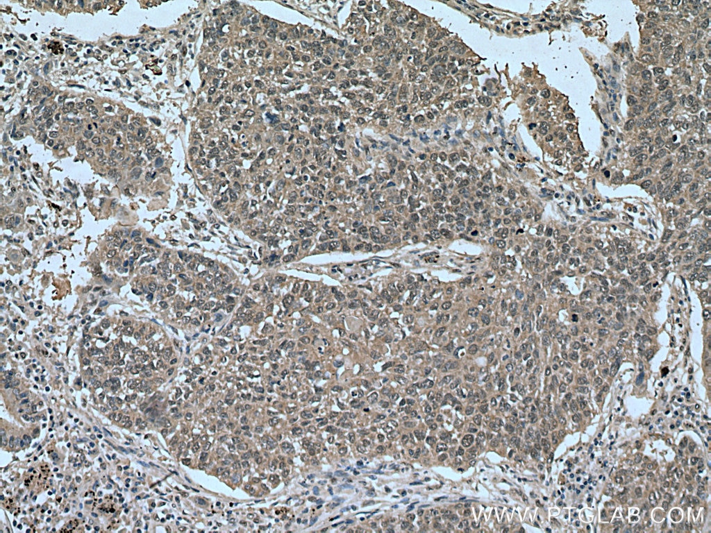Immunohistochemistry (IHC) staining of human lung cancer tissue using FOX2/RBM9 Monoclonal antibody (66976-1-Ig)