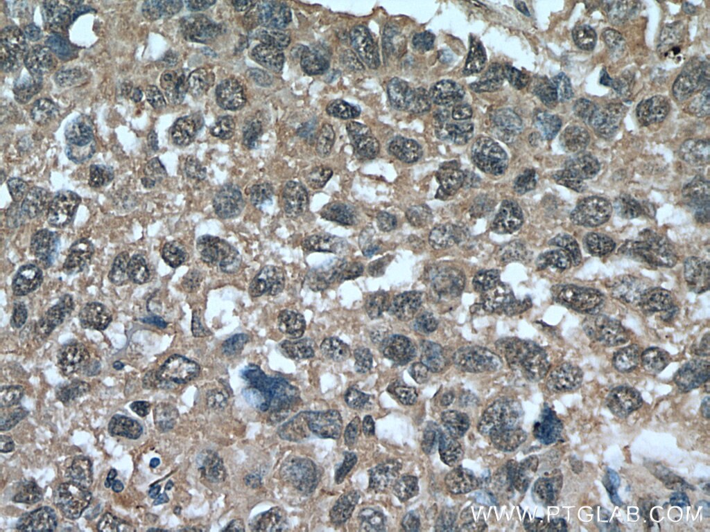 Immunohistochemistry (IHC) staining of human lung cancer tissue using FOX2/RBM9 Monoclonal antibody (66976-1-Ig)