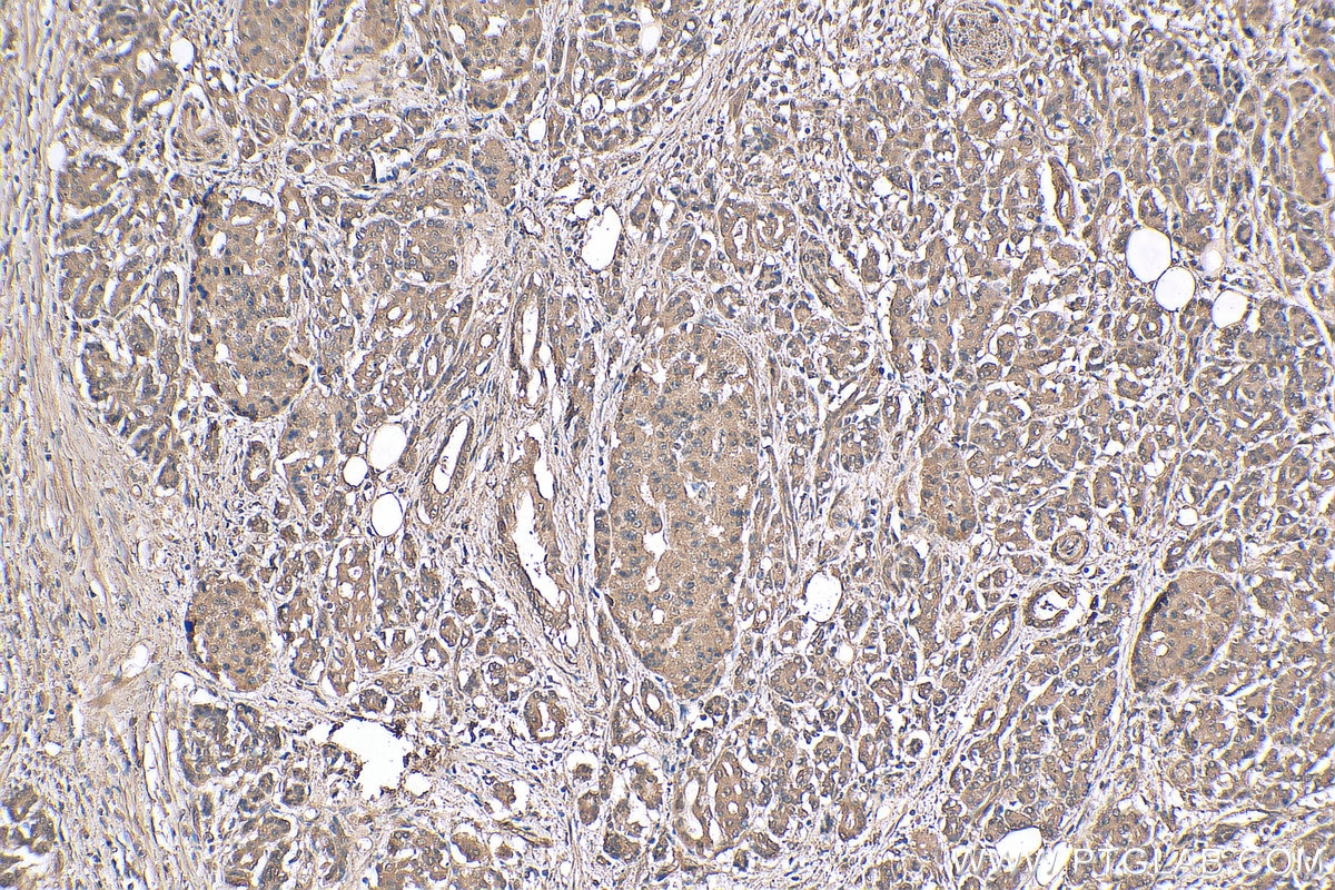 Immunohistochemistry (IHC) staining of human pancreas cancer tissue using FOX2/RBM9 Monoclonal antibody (66976-1-Ig)