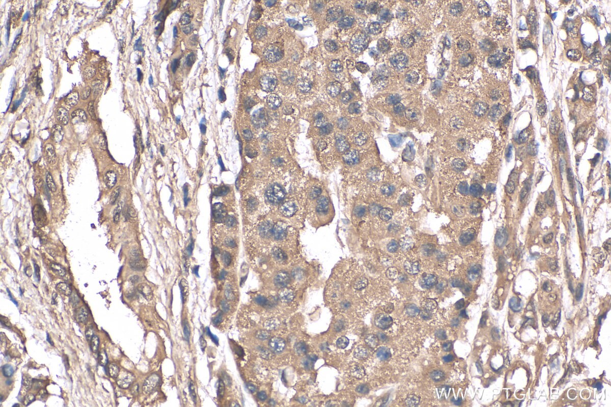 Immunohistochemistry (IHC) staining of human pancreas cancer tissue using FOX2/RBM9 Monoclonal antibody (66976-1-Ig)