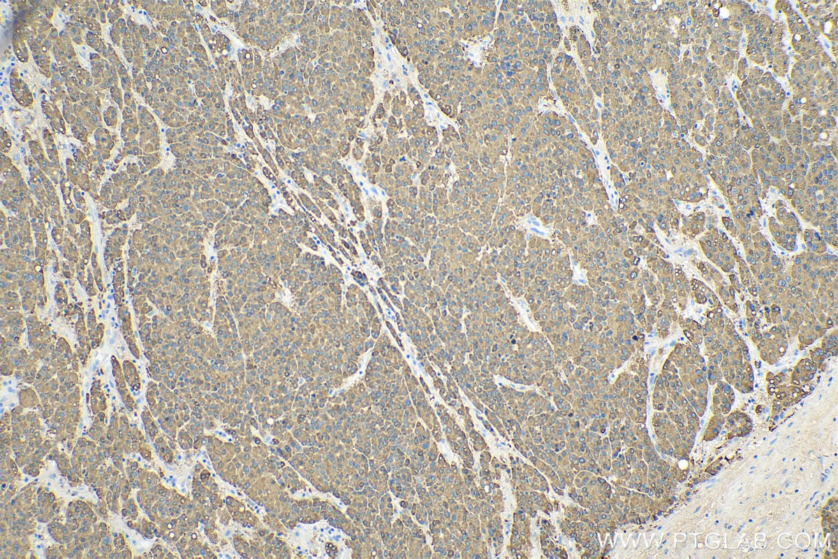 Immunohistochemistry (IHC) staining of human liver cancer tissue using RBP4 Polyclonal antibody (11774-1-AP)