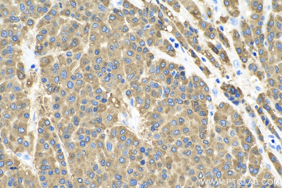 Immunohistochemistry (IHC) staining of human liver cancer tissue using RBP4 Polyclonal antibody (11774-1-AP)