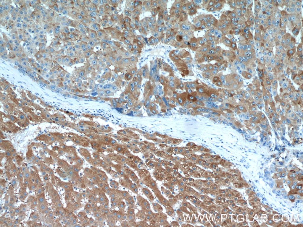 Immunohistochemistry (IHC) staining of human liver cancer tissue using RBP4 Polyclonal antibody (11774-1-AP)