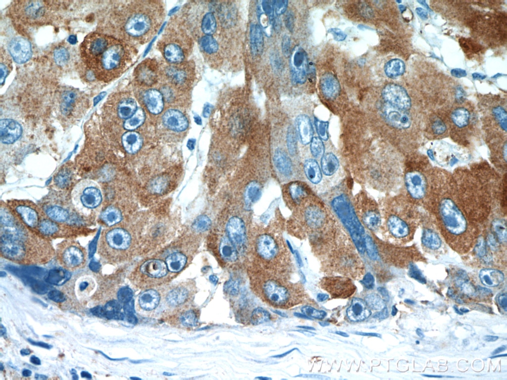 Immunohistochemistry (IHC) staining of human liver cancer tissue using RBP4 Polyclonal antibody (11774-1-AP)