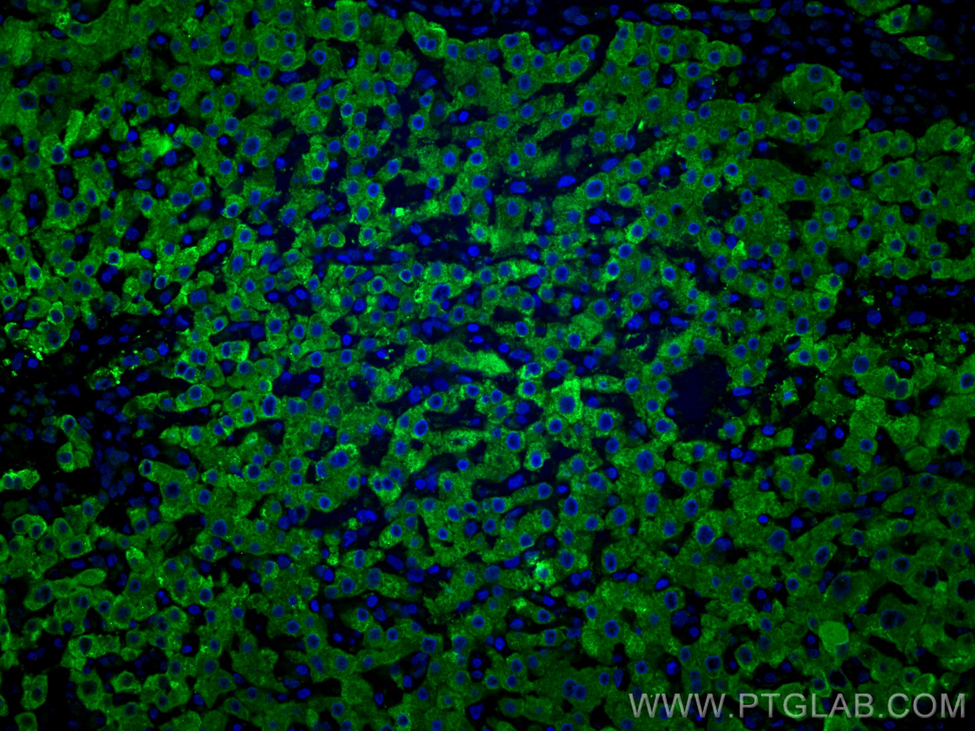 Immunofluorescence (IF) / fluorescent staining of human liver cancer tissue using RBP4 Monoclonal antibody (66104-1-Ig)