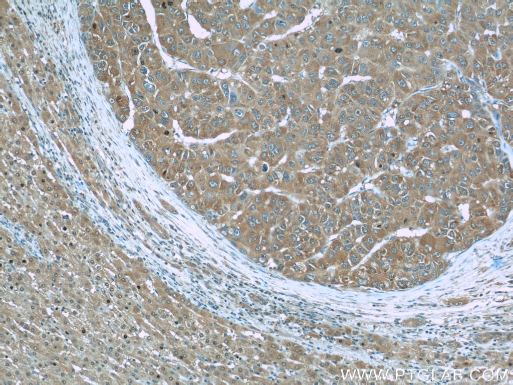 Immunohistochemistry (IHC) staining of human liver cancer tissue using RBP4 Monoclonal antibody (66104-1-Ig)