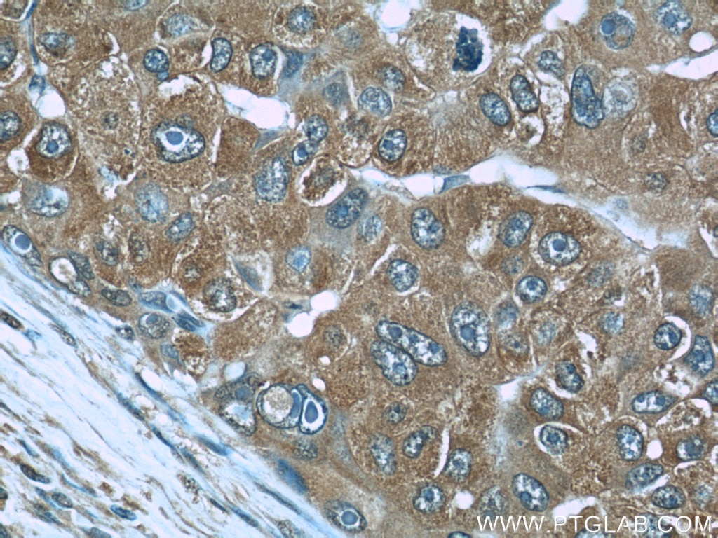 Immunohistochemistry (IHC) staining of human liver cancer tissue using RBP4 Monoclonal antibody (66104-1-Ig)