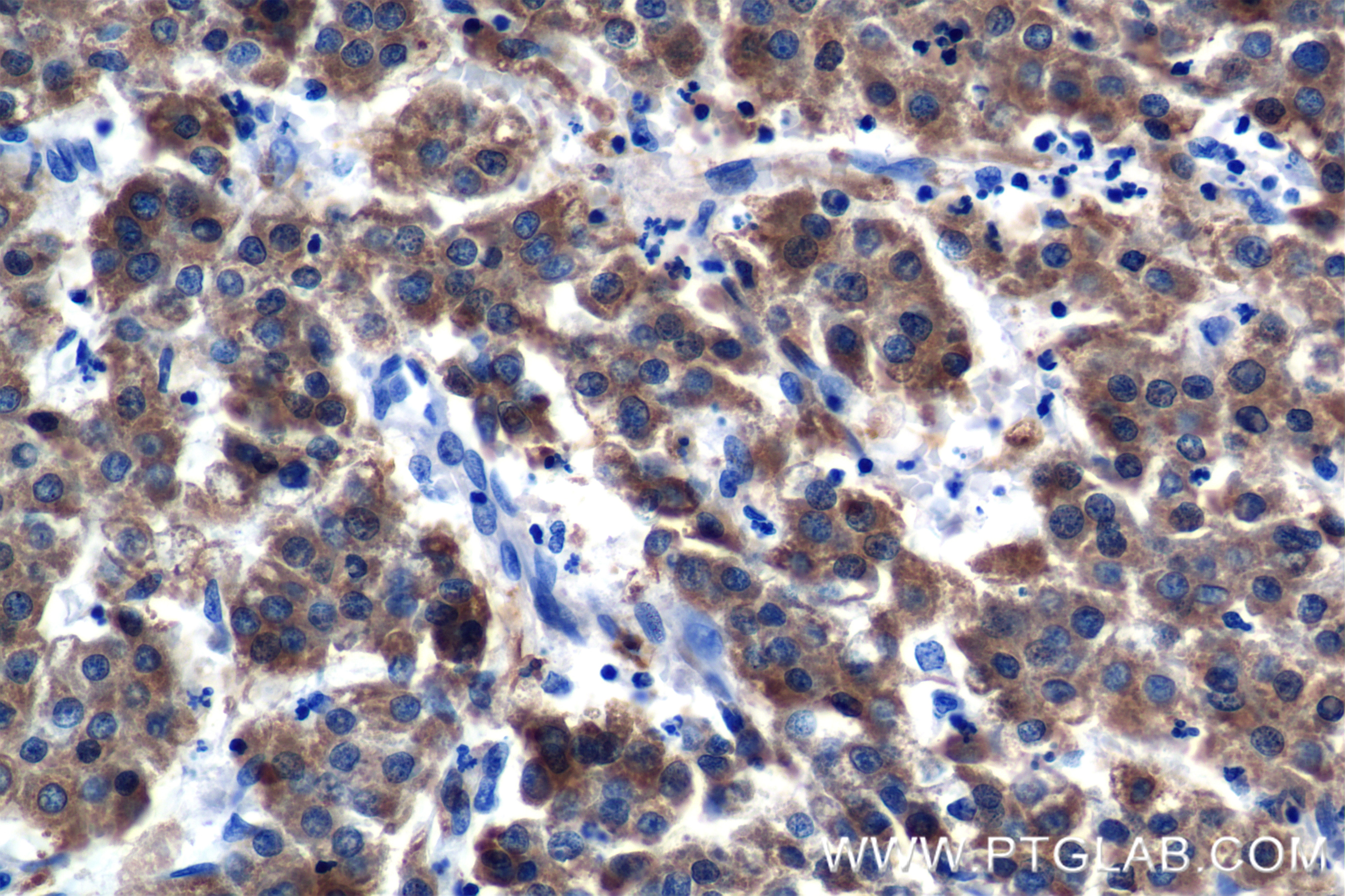 Immunohistochemistry (IHC) staining of Human Hepatocellular cancer using RBP4 Recombinant antibody (84496-4-RR)