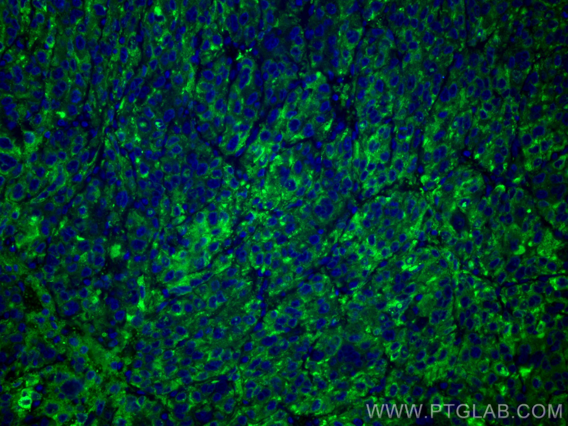 Immunofluorescence (IF) / fluorescent staining of human liver cancer tissue using CoraLite® Plus 488-conjugated RBP4 Monoclonal anti (CL488-66104)